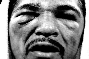 antonio-margarito-eye